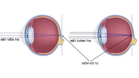 Cách khắc phục mắt bị viễn thị