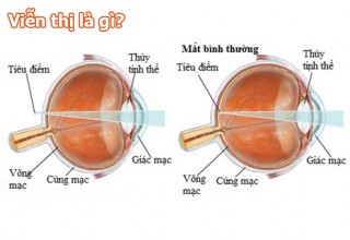 Cách khắc phục mắt bị viễn thị